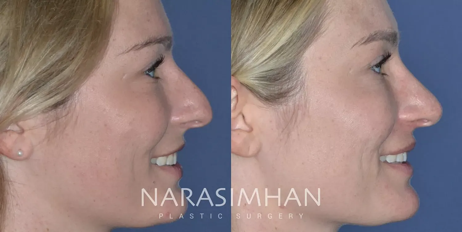 Facial Sculpting Before & After