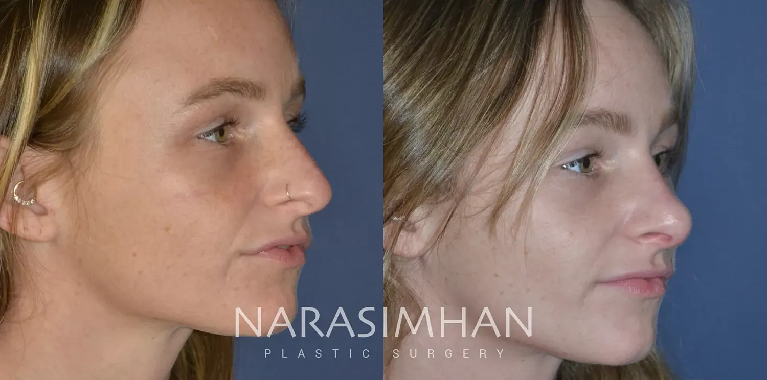 Facial Sculpting Before & After