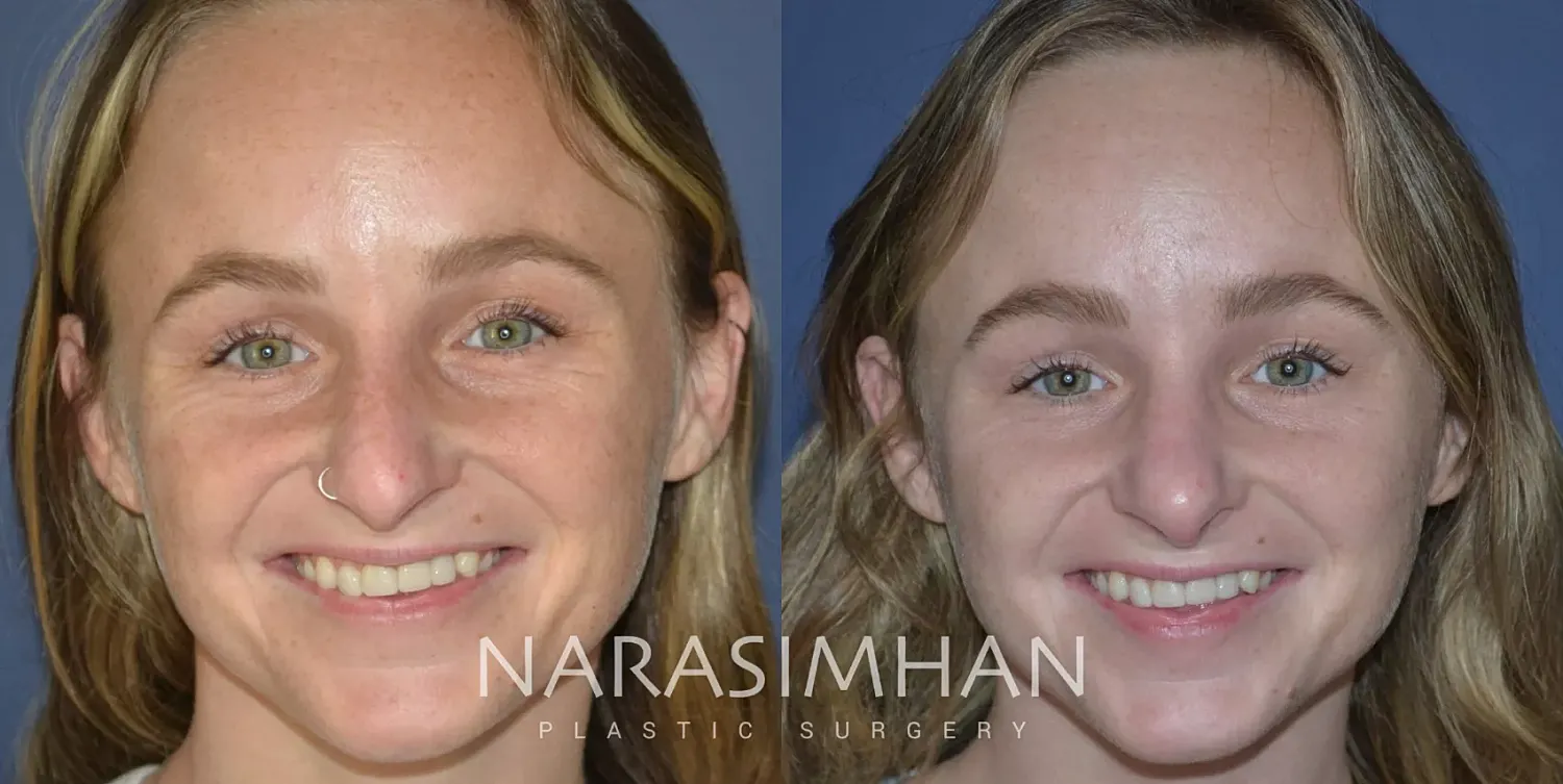 Facial Sculpting Before & After