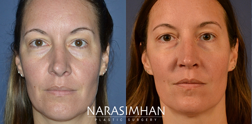 Facial Sculpting Before & After