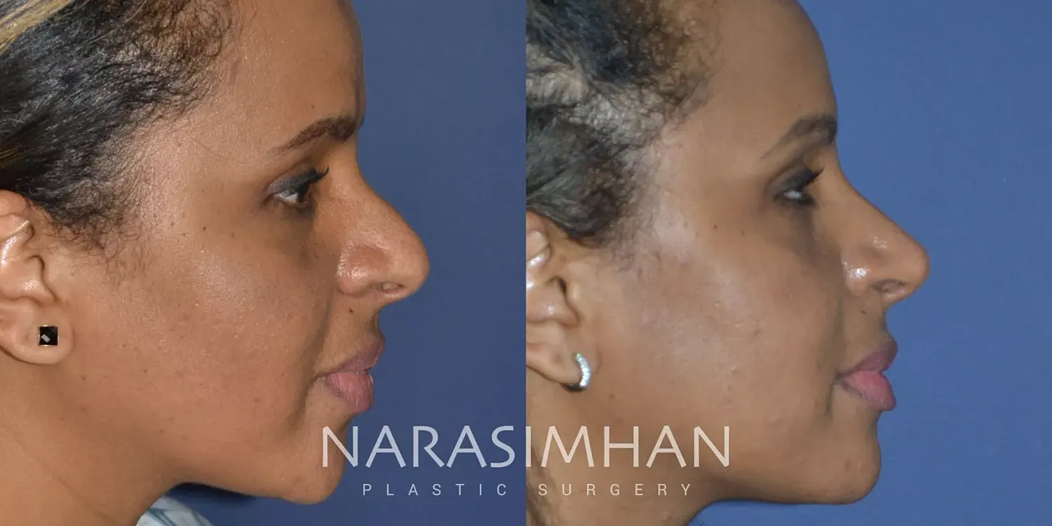 Facial Sculpting Before & After