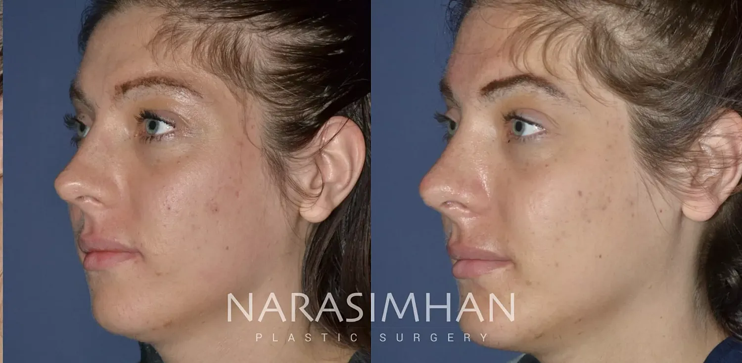 Facial Sculpting Before & After