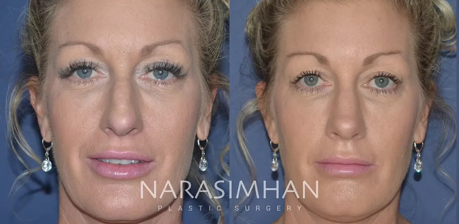 Facial Sculpting Before & After