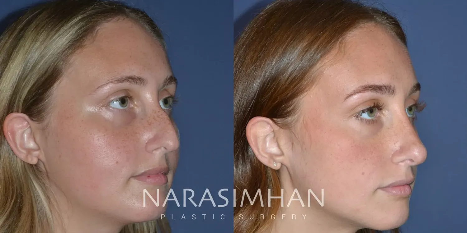 Facial Sculpting Before & After