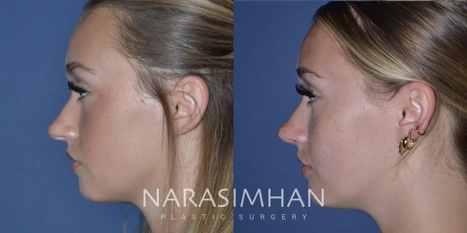 Facial Sculpting Before & After