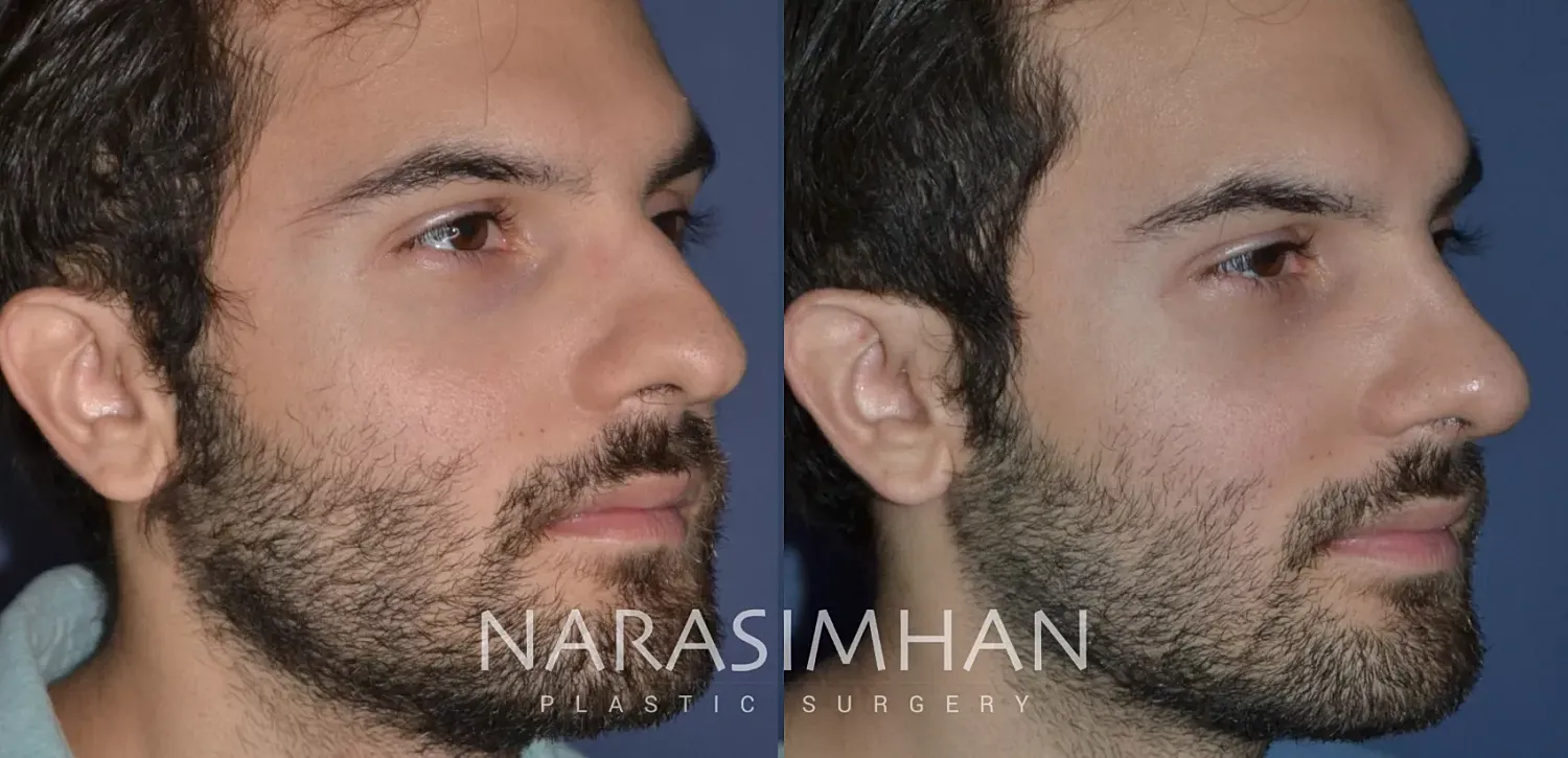 Facial Sculpting Before & After