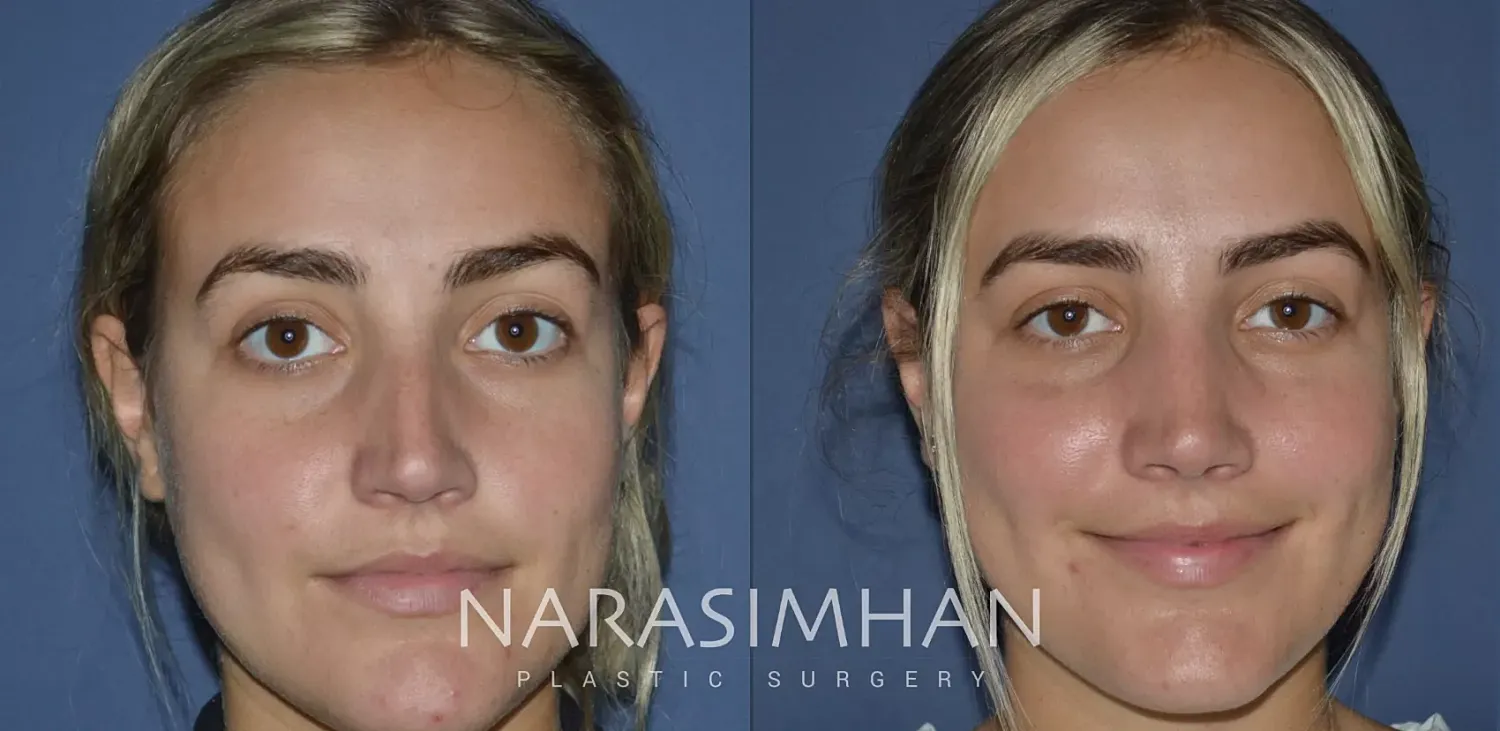 Facial Sculpting Before & After