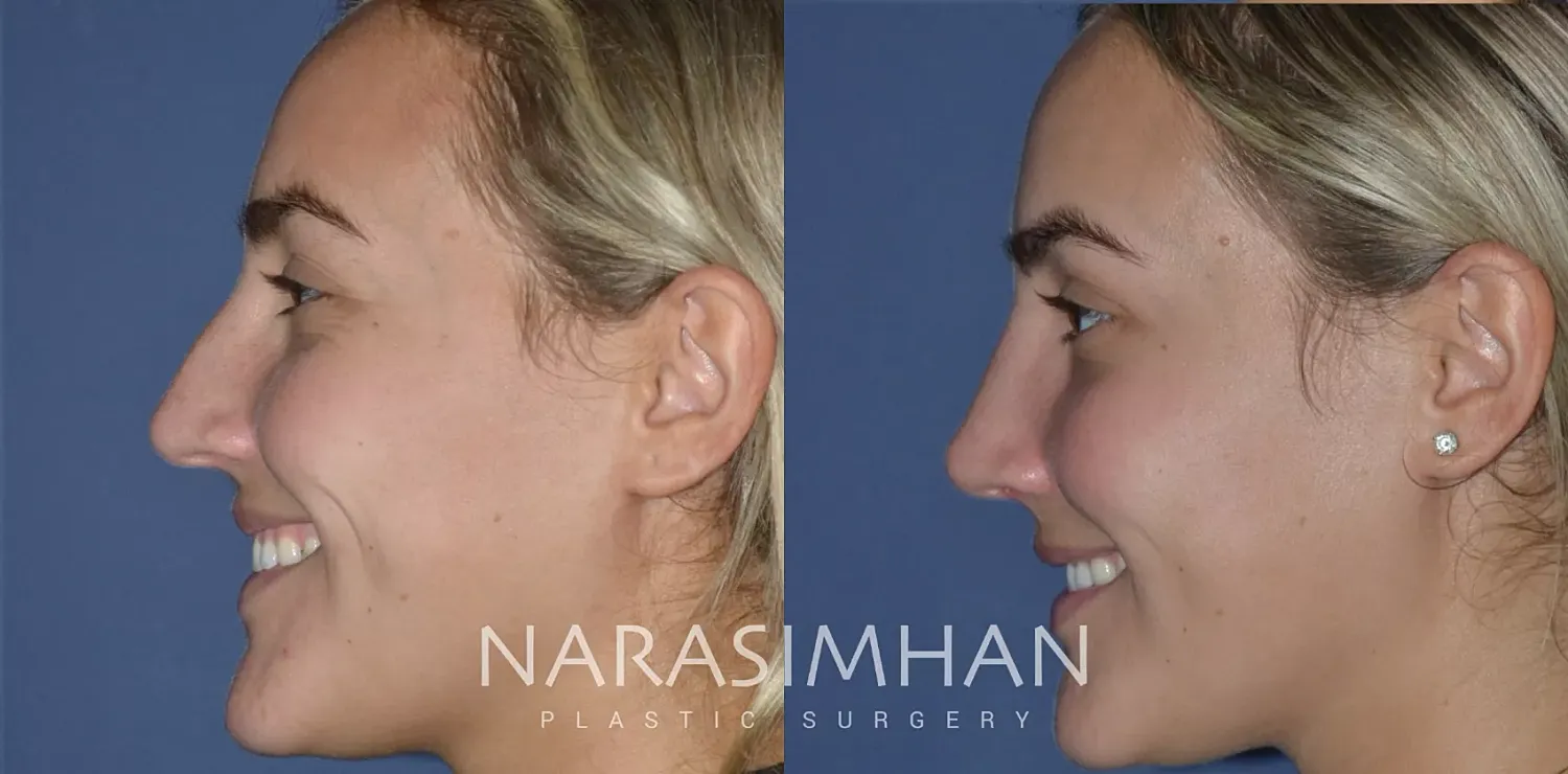 Facial Sculpting Before & After