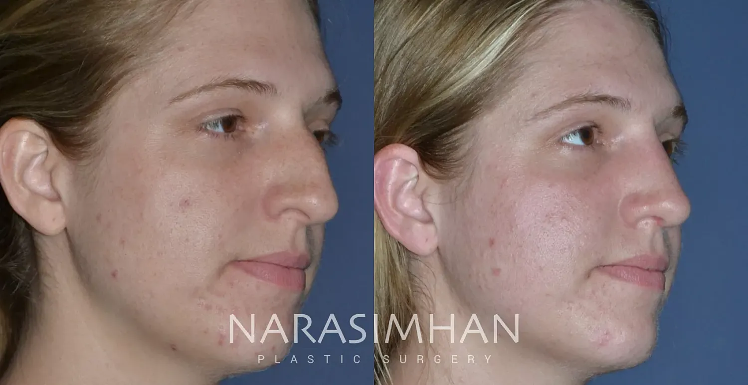 Facial Sculpting Before & After