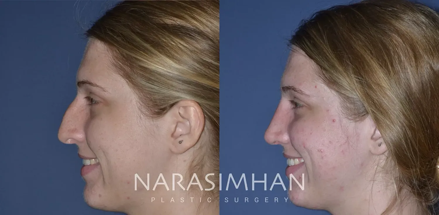 Facial Sculpting Before & After