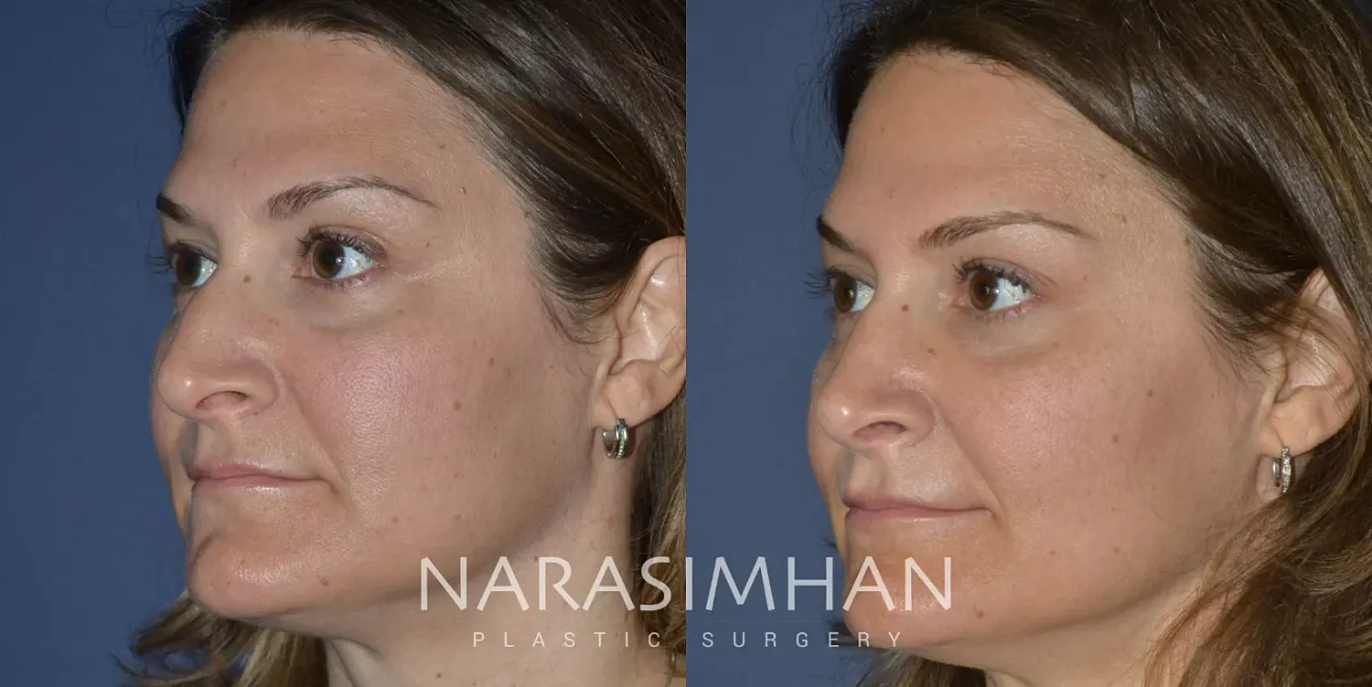 Facial Sculpting Before & After