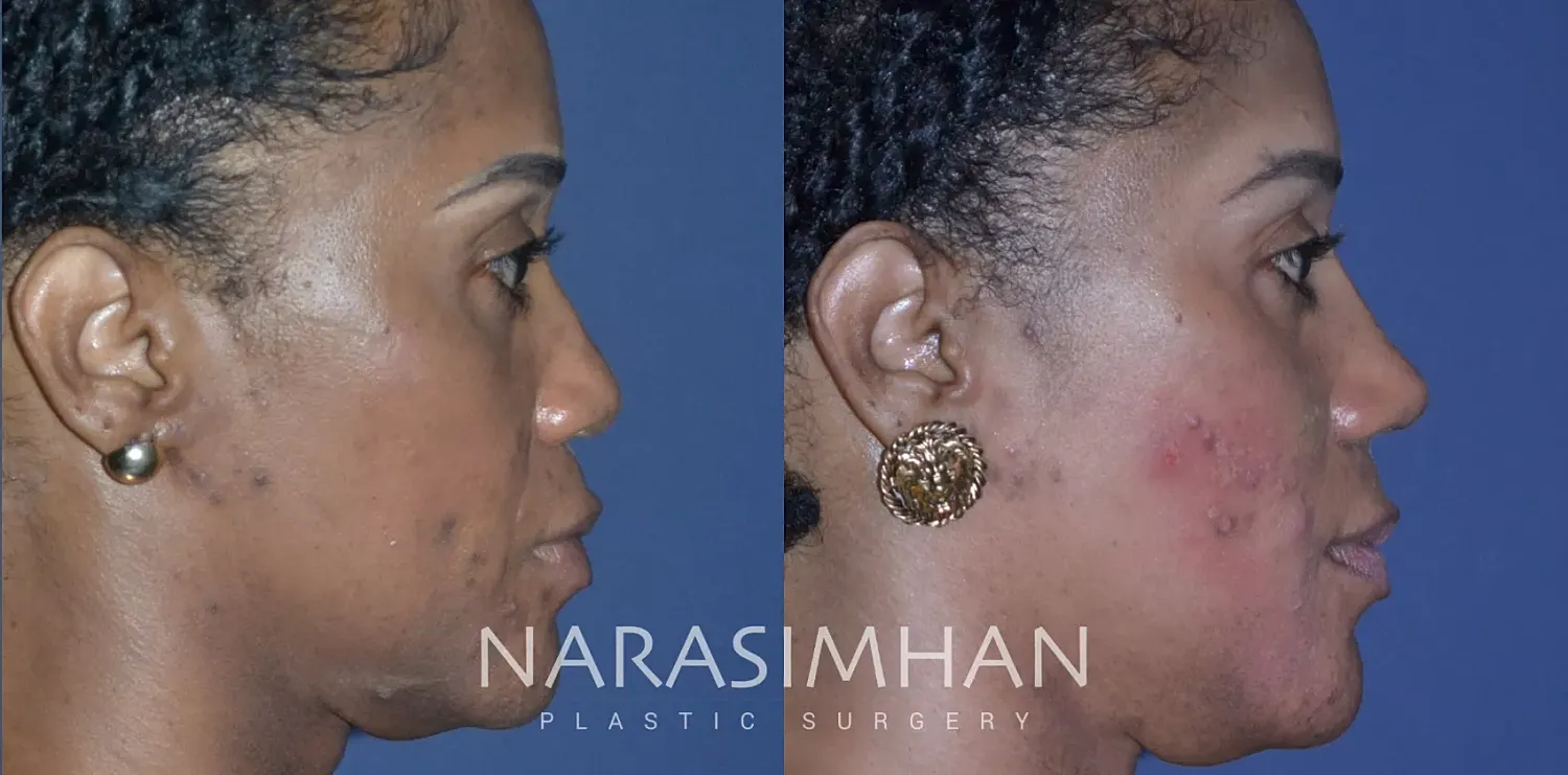 Facial Sculpting Before & After