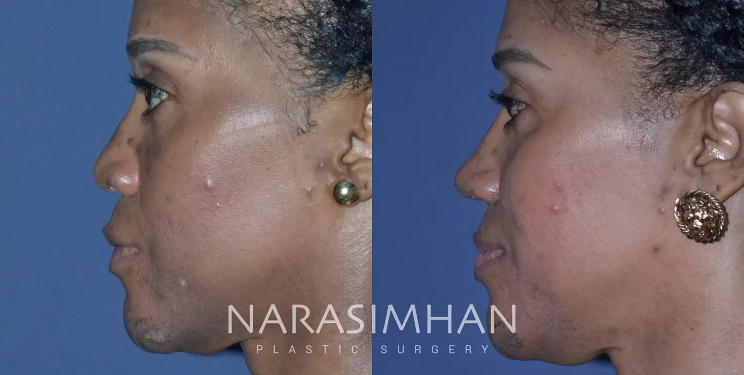 Facial Sculpting Before & After