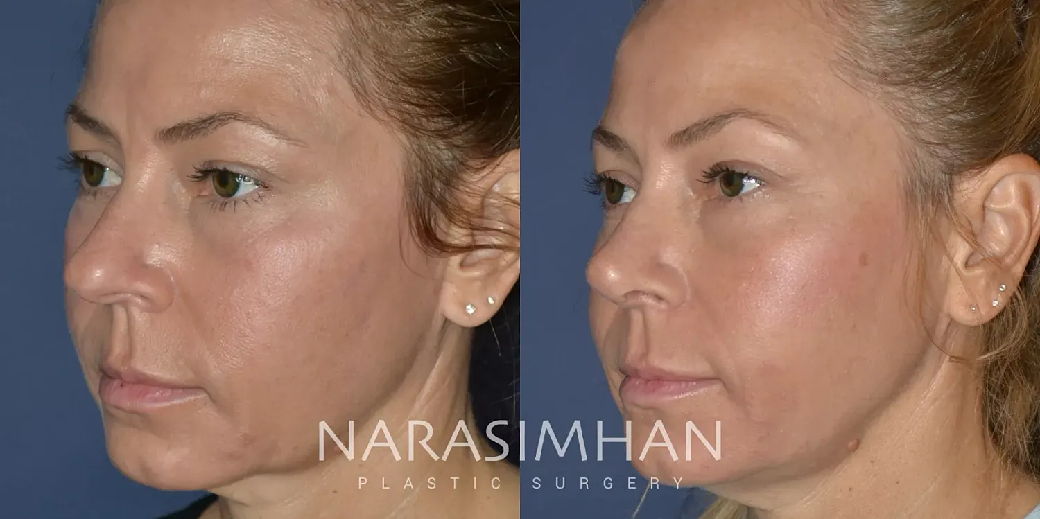 Facial Sculpting Before & After