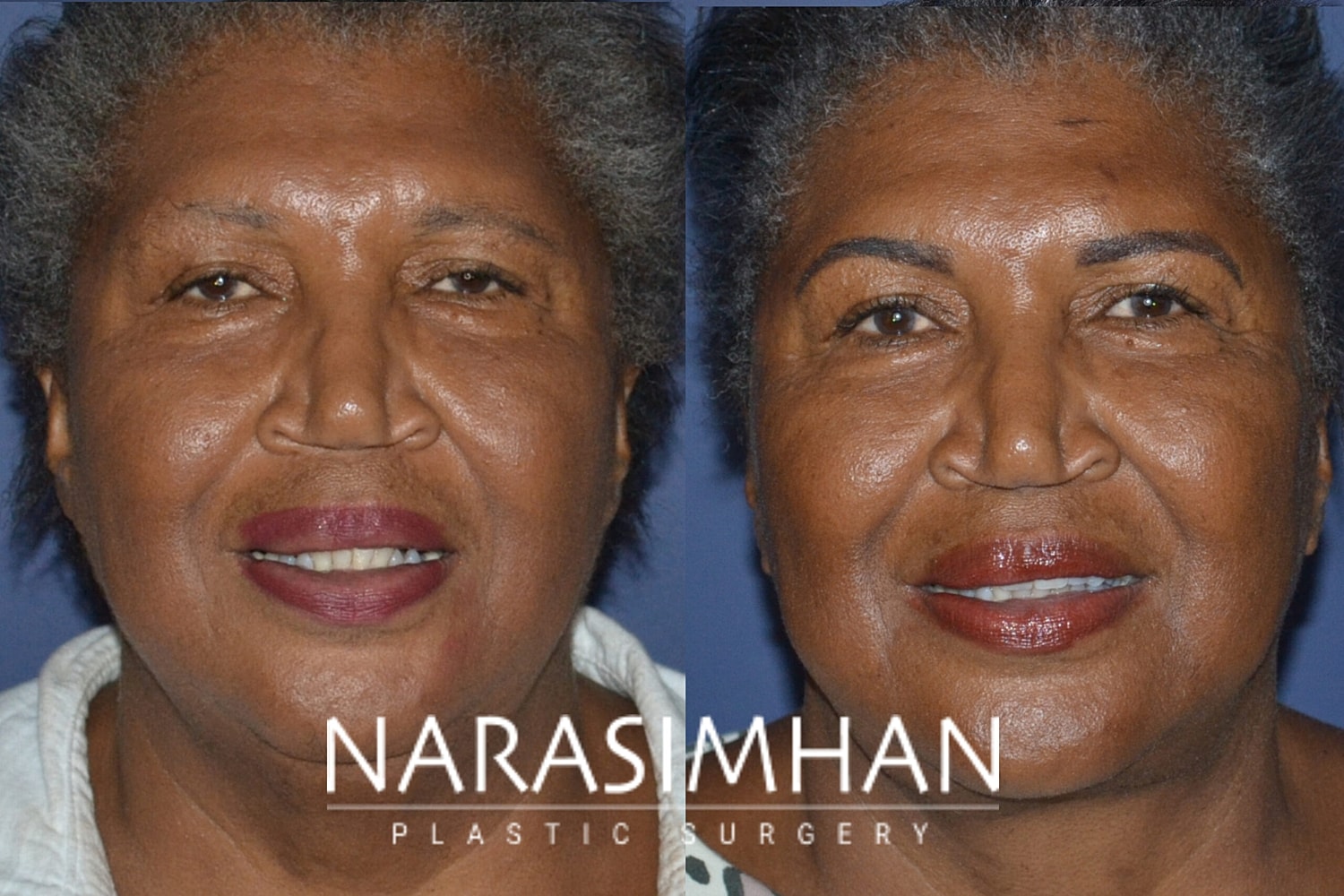 Facial Sculpting Before & After
