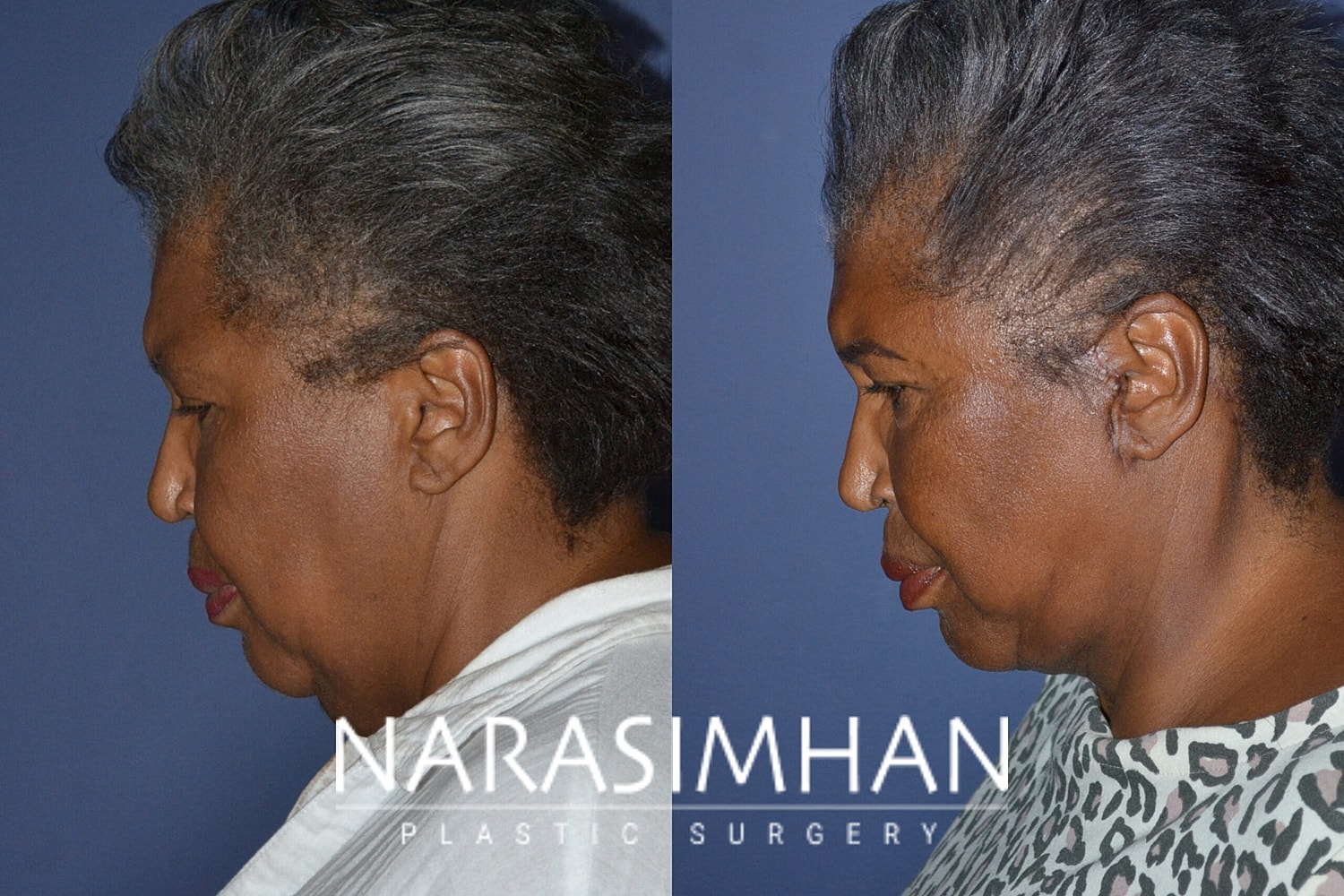 Facial Sculpting Before & After