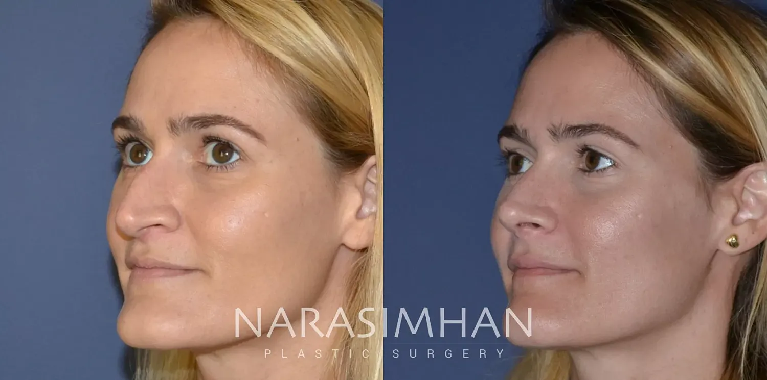 Facial Sculpting Before & After