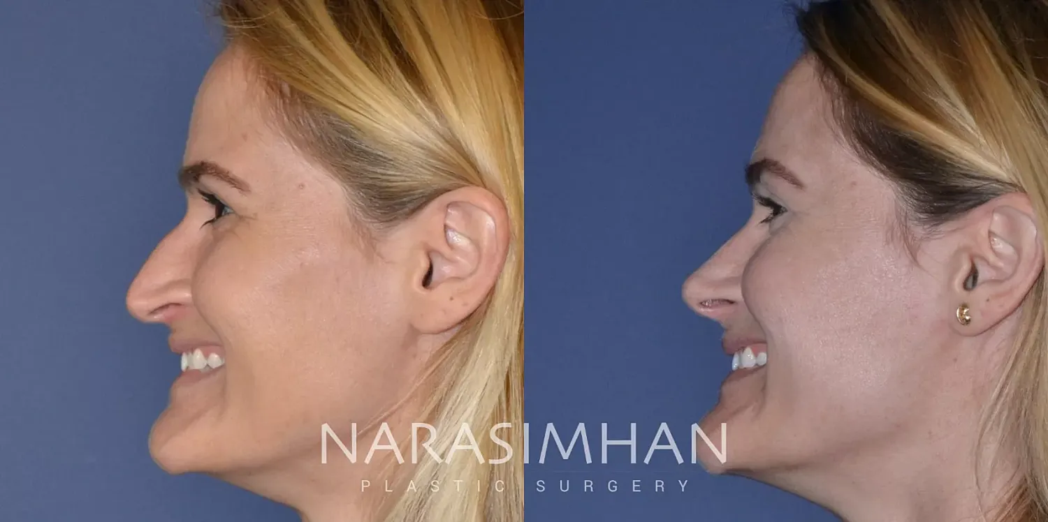Facial Sculpting Before & After