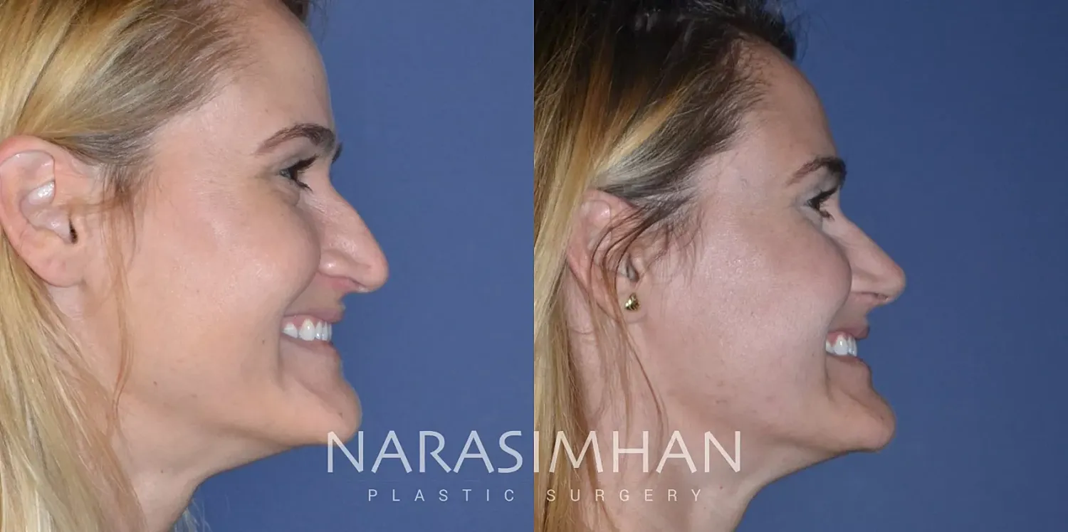 Facial Sculpting Before & After