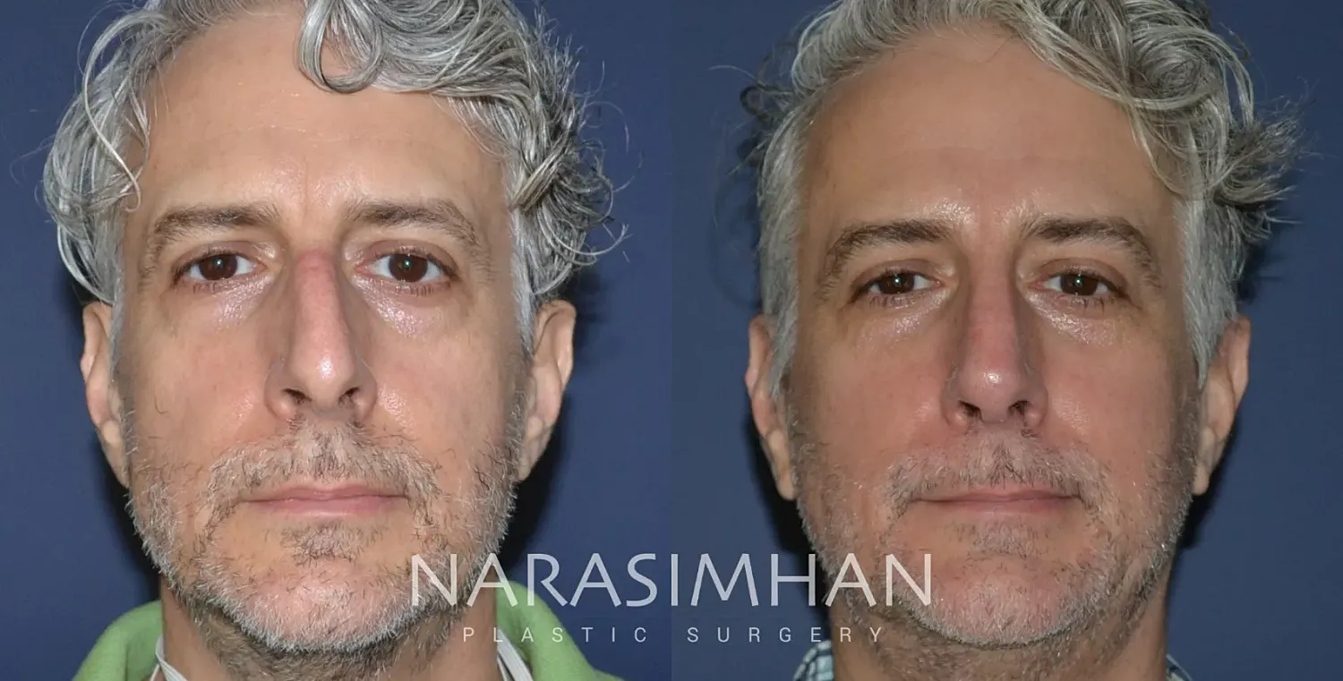 Facial Sculpting Before & After