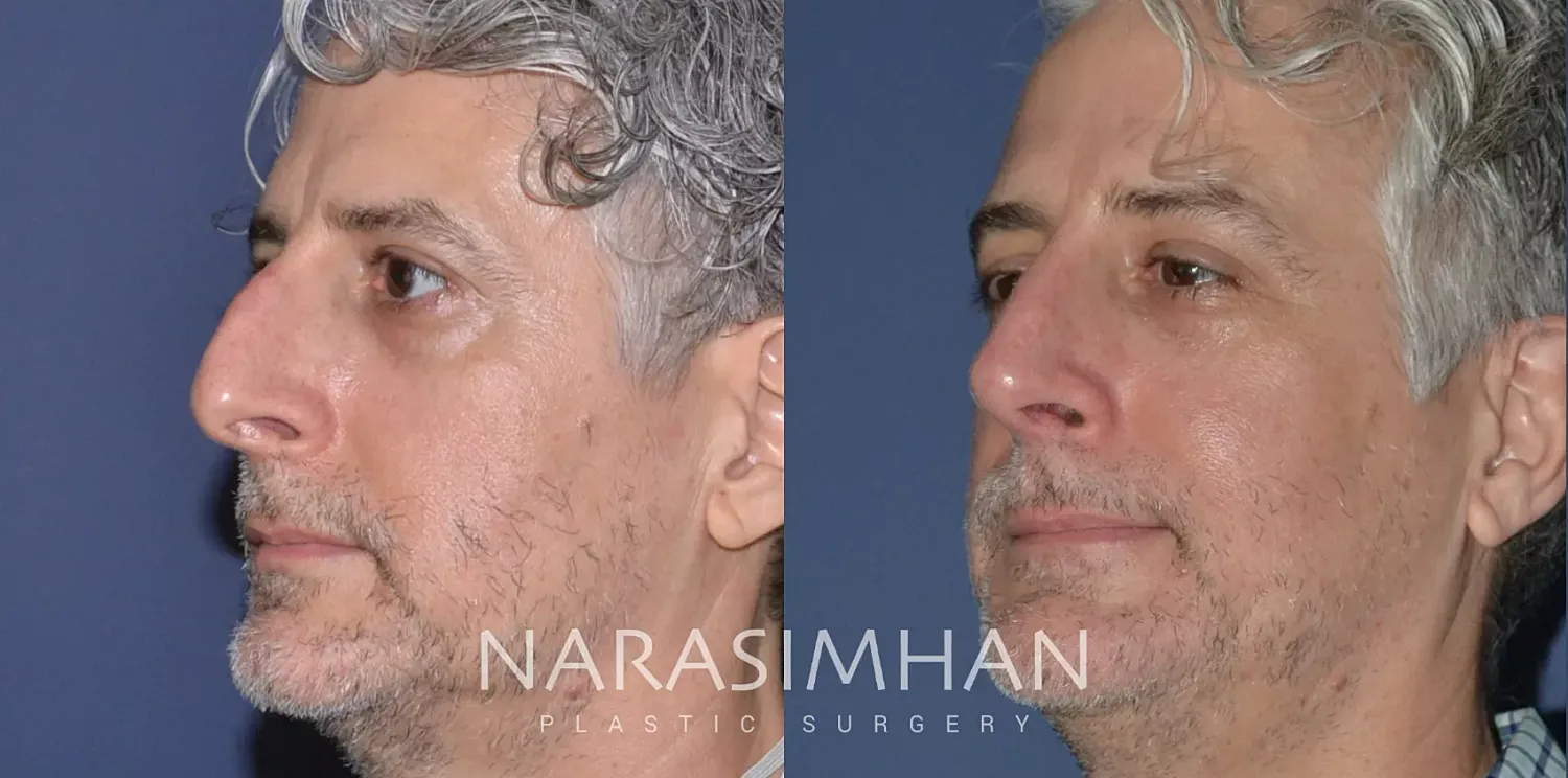 Facial Sculpting Before & After