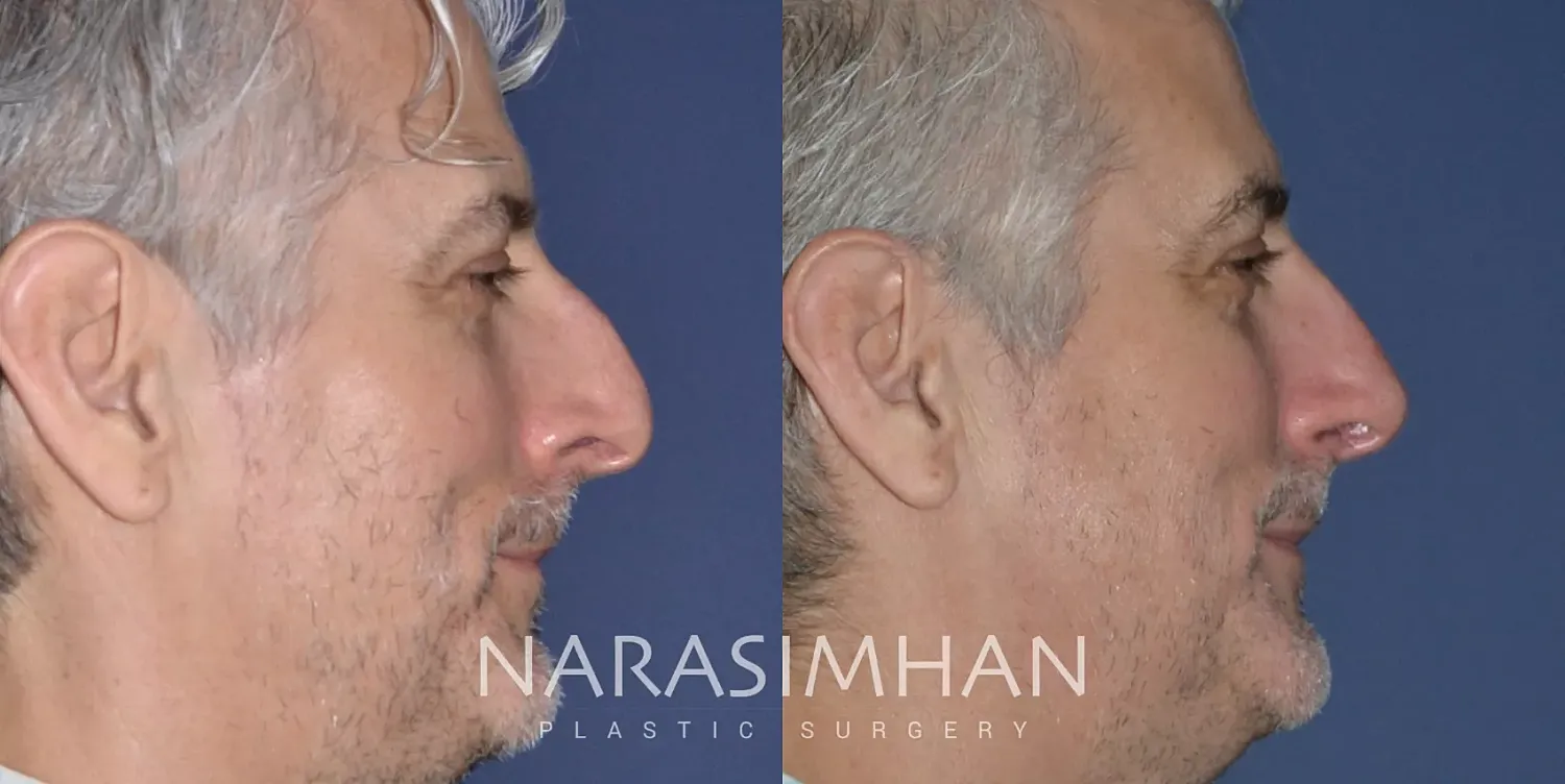 Facial Sculpting Before & After