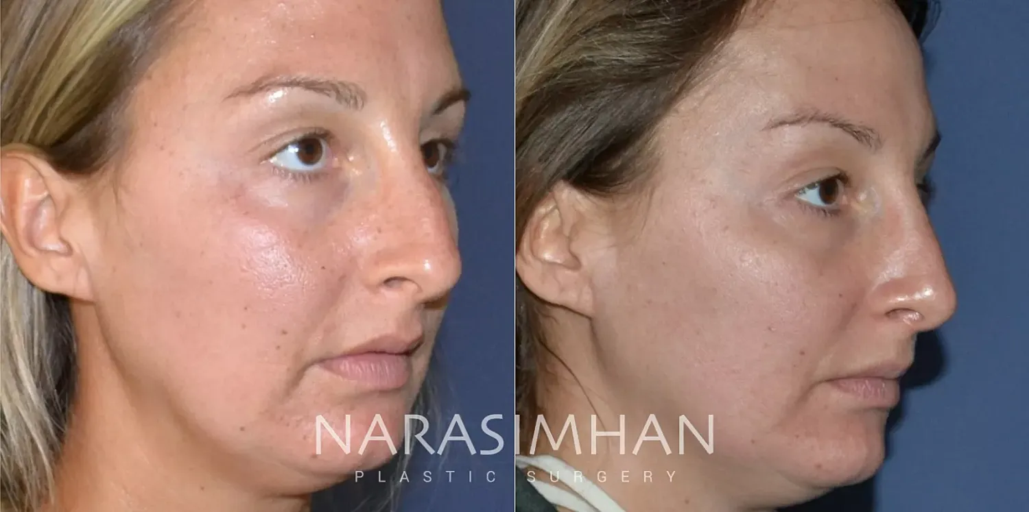 Facial Sculpting Before & After