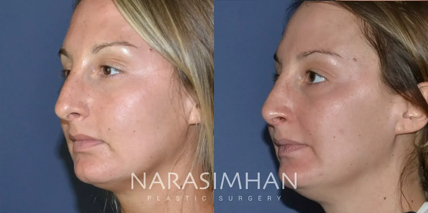 Facial Sculpting Before & After