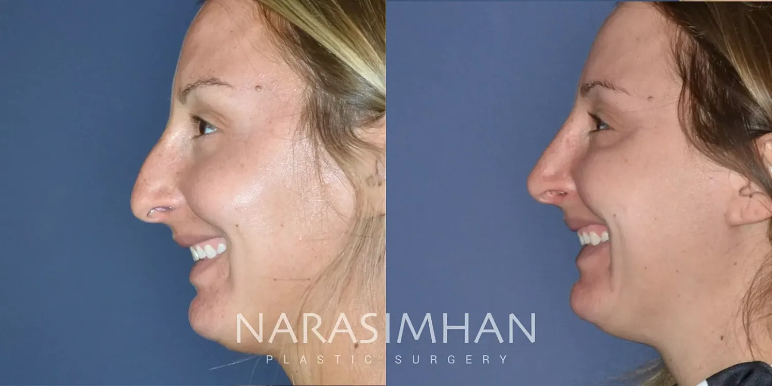 Facial Sculpting Before & After