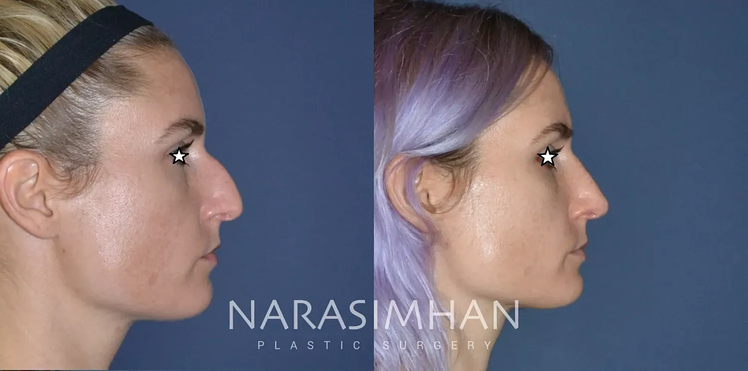 Facial Sculpting Before & After