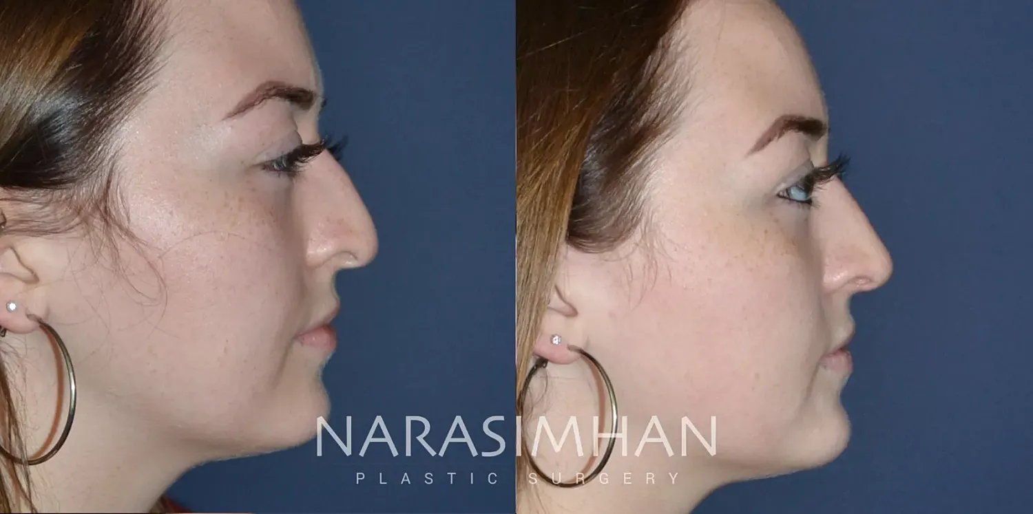 Facial Sculpting Before & After