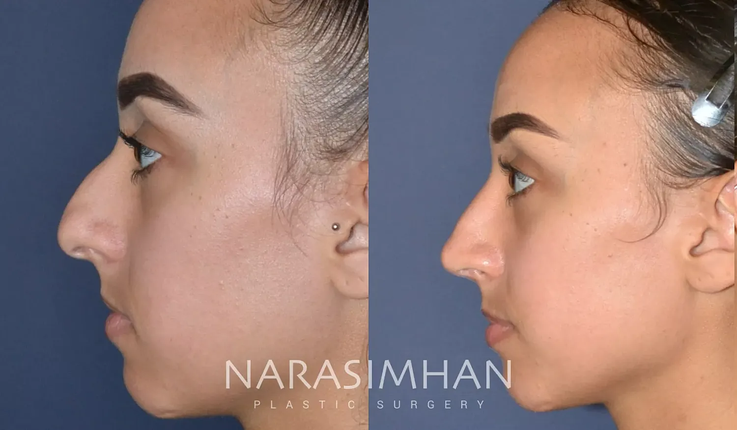 Facial Sculpting Before & After