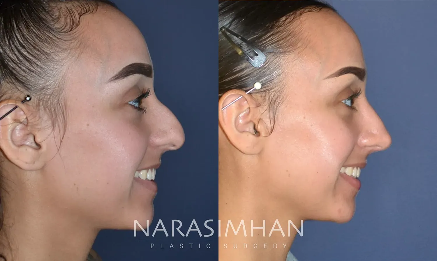 Facial Sculpting Before & After
