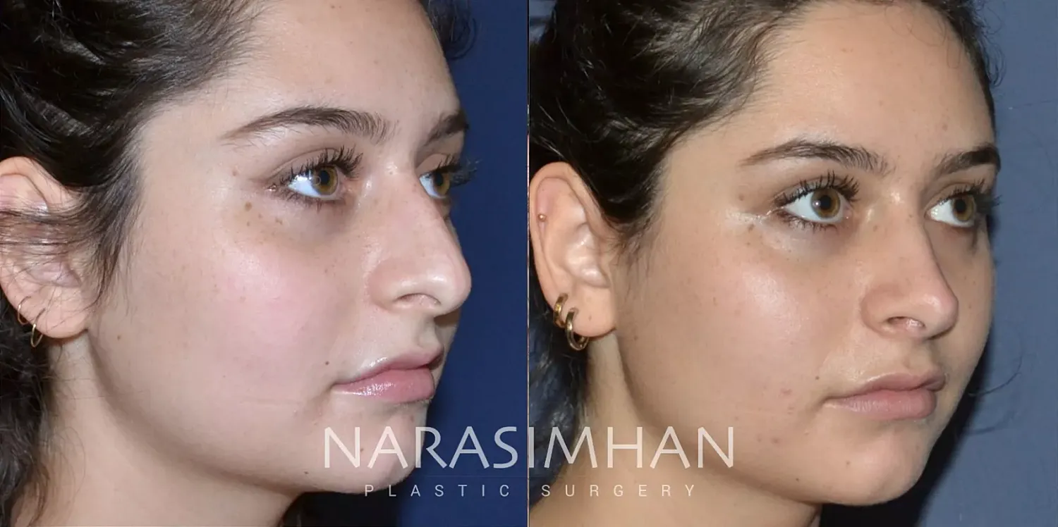 Facial Sculpting Before & After