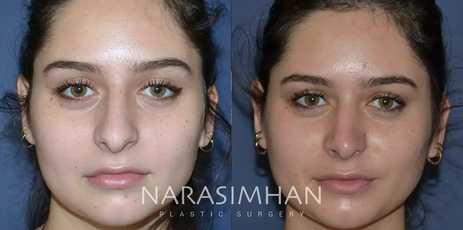 Facial Sculpting Before & After