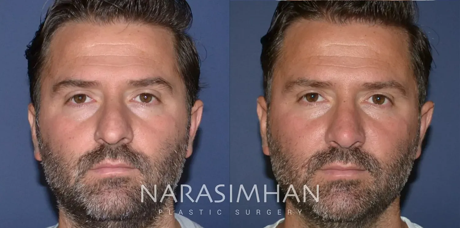 Facial Sculpting Before & After