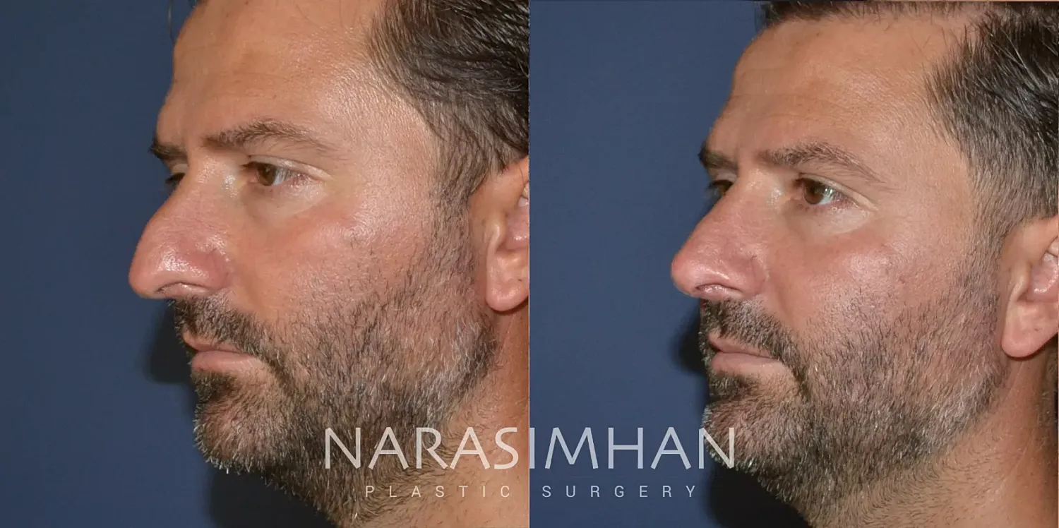 Facial Sculpting Before & After