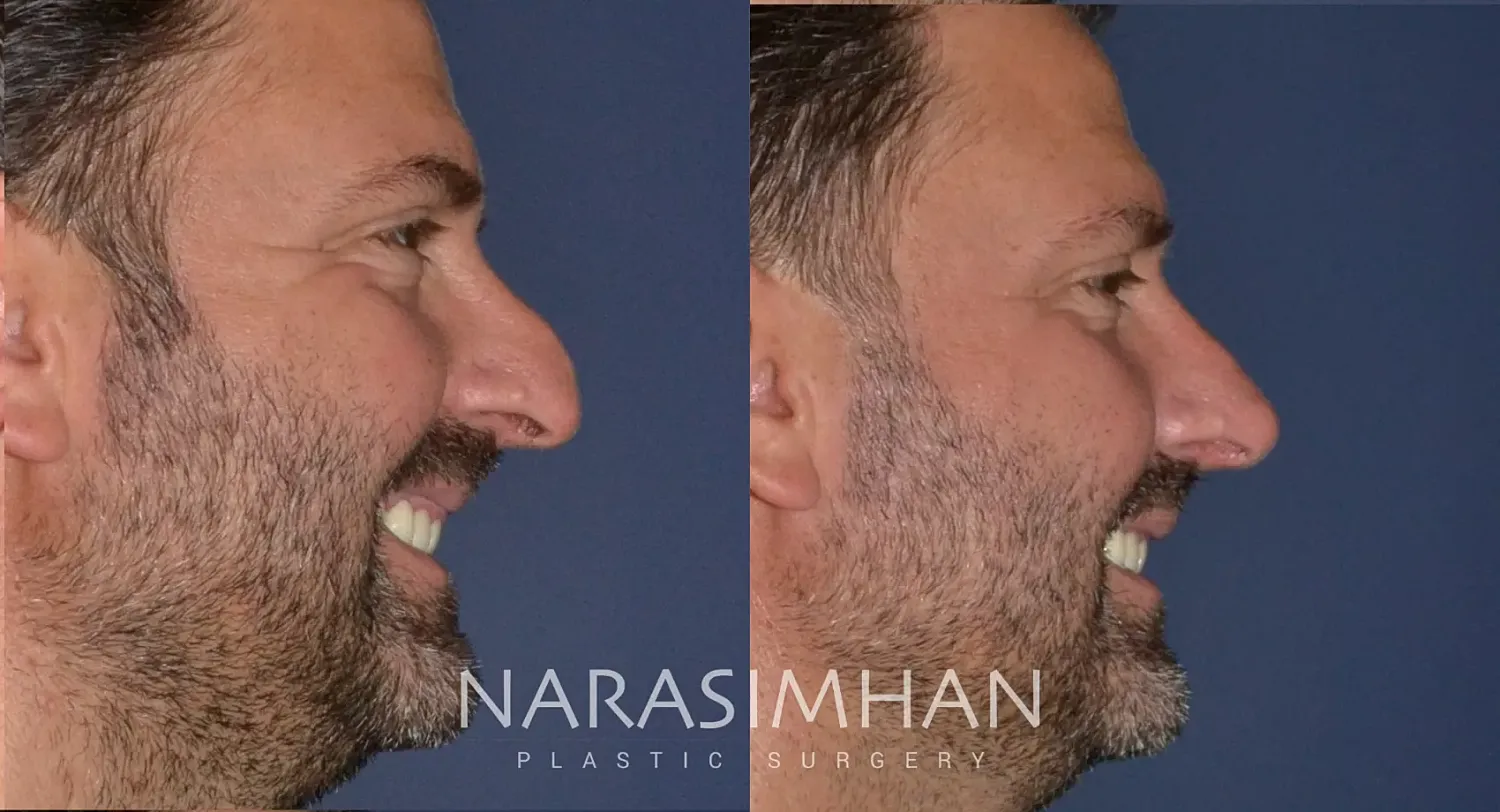 Facial Sculpting Before & After