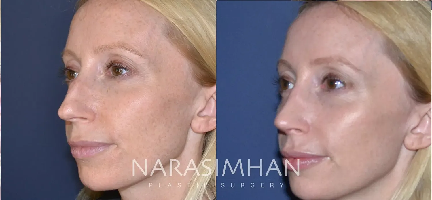 Facial Sculpting Before & After
