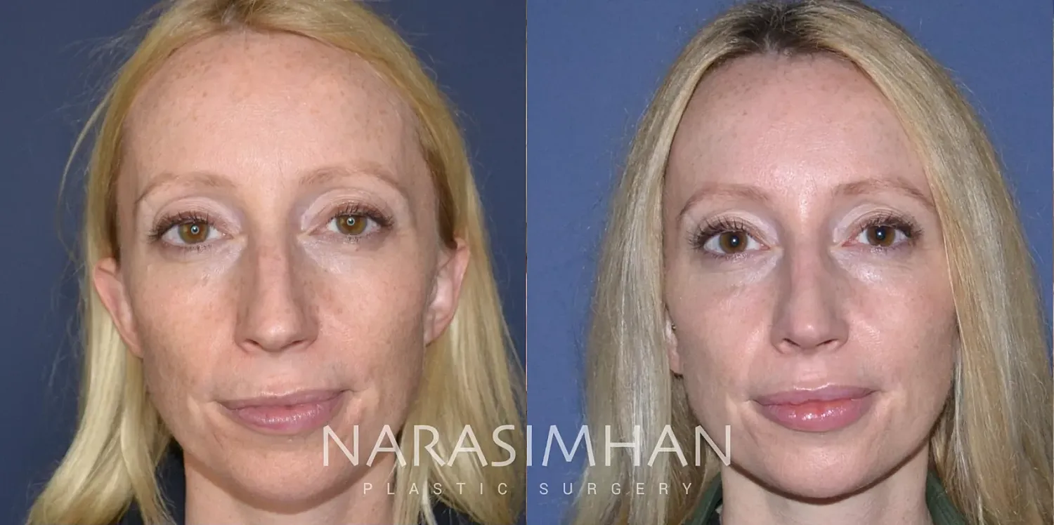 Facial Sculpting Before & After