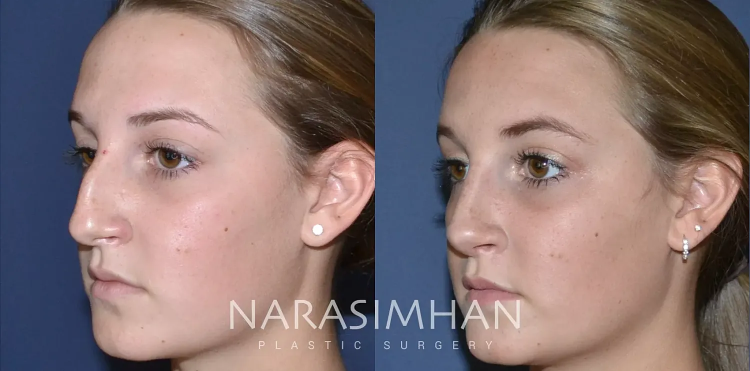 Facial Sculpting Before & After