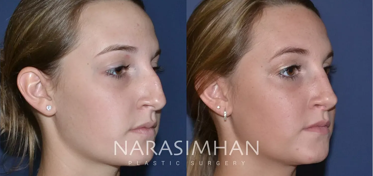 Facial Sculpting Before & After