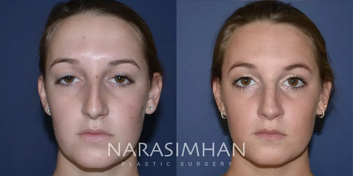Facial Sculpting Before & After