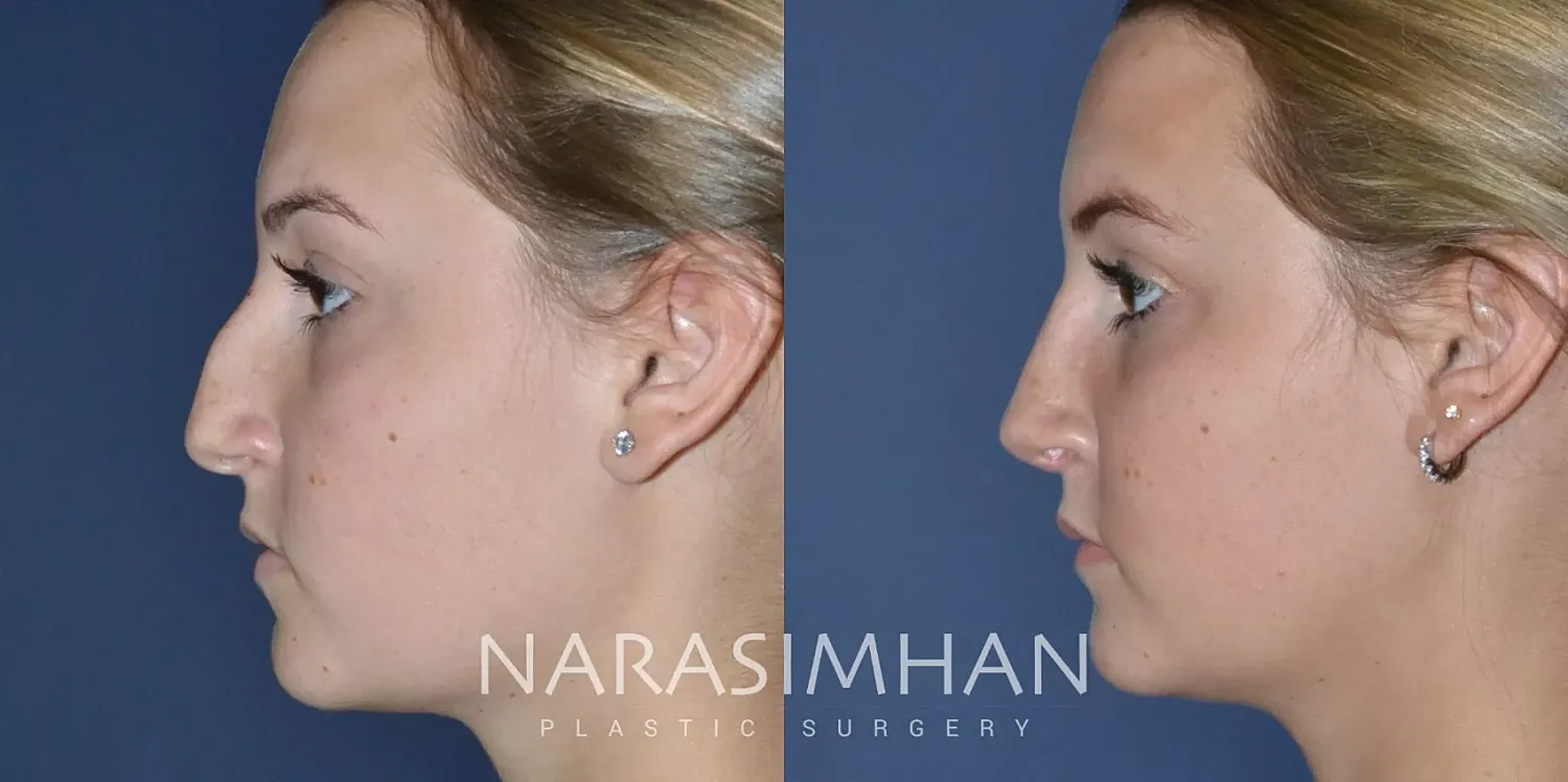 Facial Sculpting Before & After