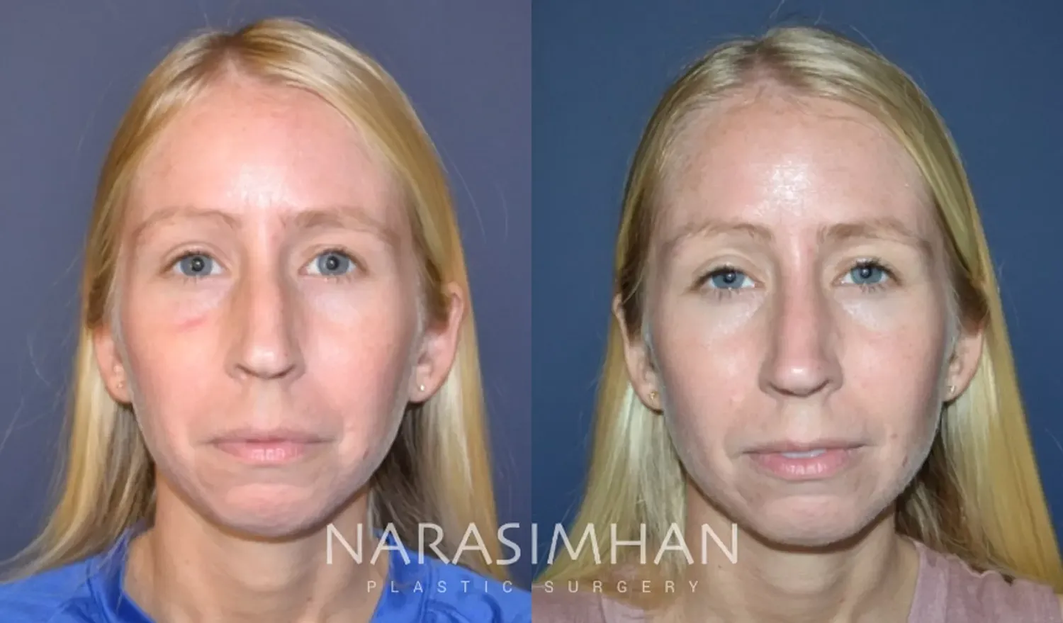 Facial Sculpting Before & After