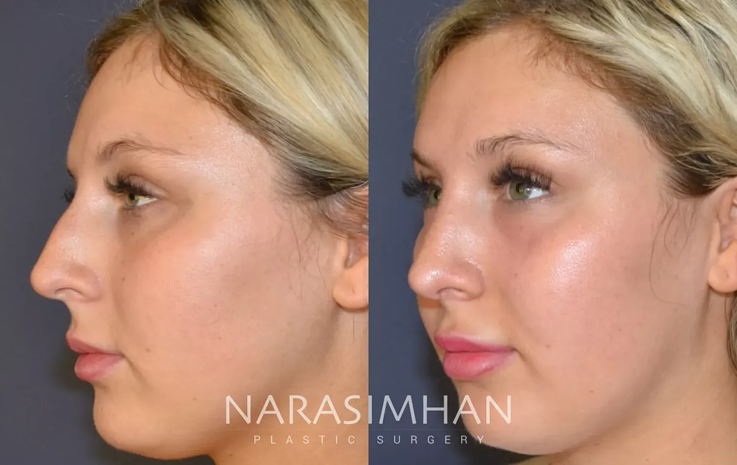 Facial Sculpting Before & After