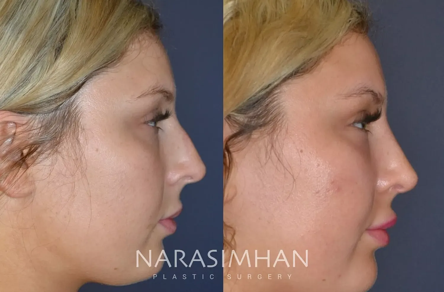 Facial Sculpting Before & After