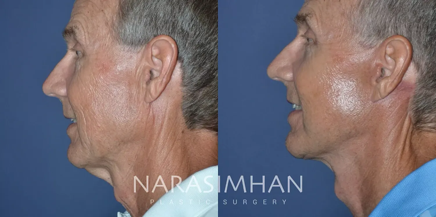 Facial Sculpting Before & After