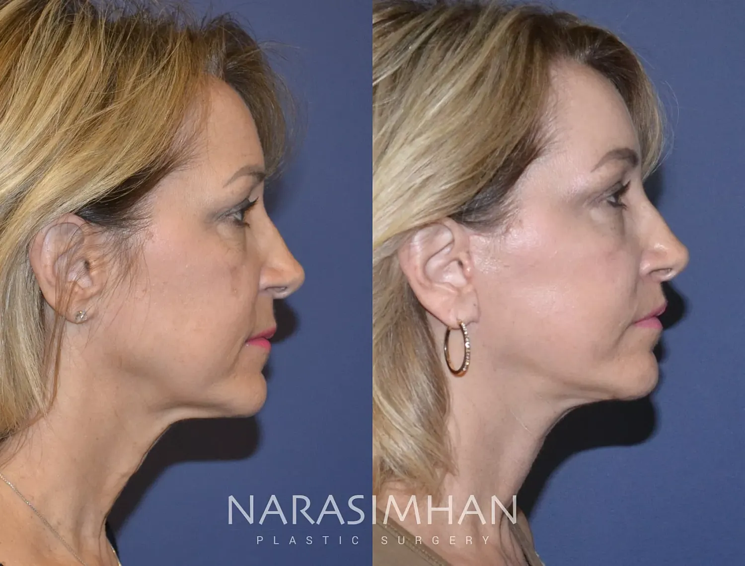 Facial Sculpting Before & After