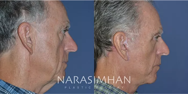 Facial Sculpting Before & After